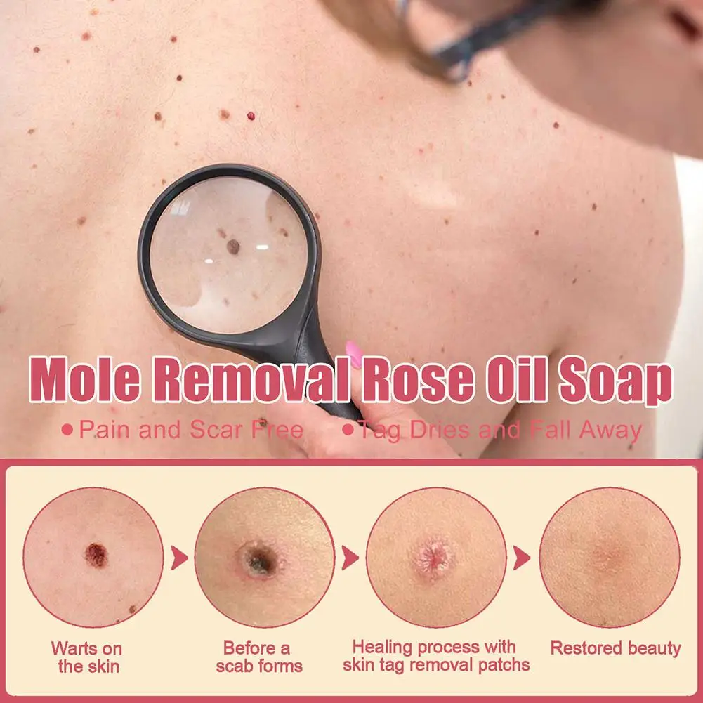 

80g Warts Remover Rose Oil Soap Tags Pimple Treatments Brightening Essence Freckle Deep Black Spot Cleaning Soap Improve Y9F4