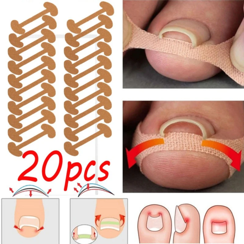 Ingrown Toenail Corrector Sticker Nail Strip Antiroll Nail Free Glue Toe Inlay Nail Corrector
