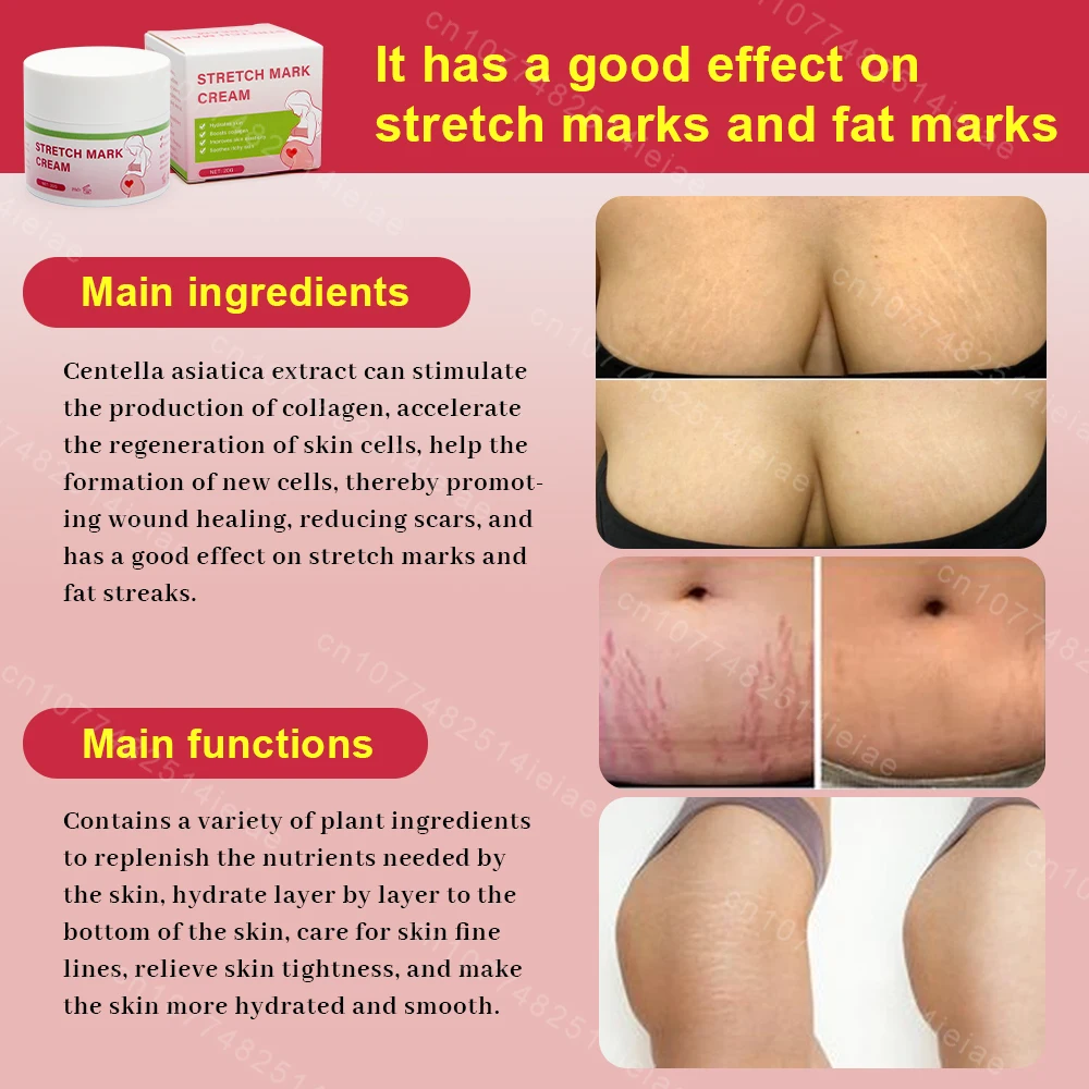 Pregnancy Mark Removal Cream Permanent Repairs Damaged Skin Natural Ingredients Remove Abdominal Pregnancy Line Without Stains