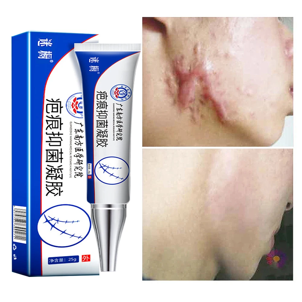 

Acne Scar Removal Cream Pimples Stretch Marks Face Gel Remove Acne Smoothing Whitening Moisturizing Body Skin Care