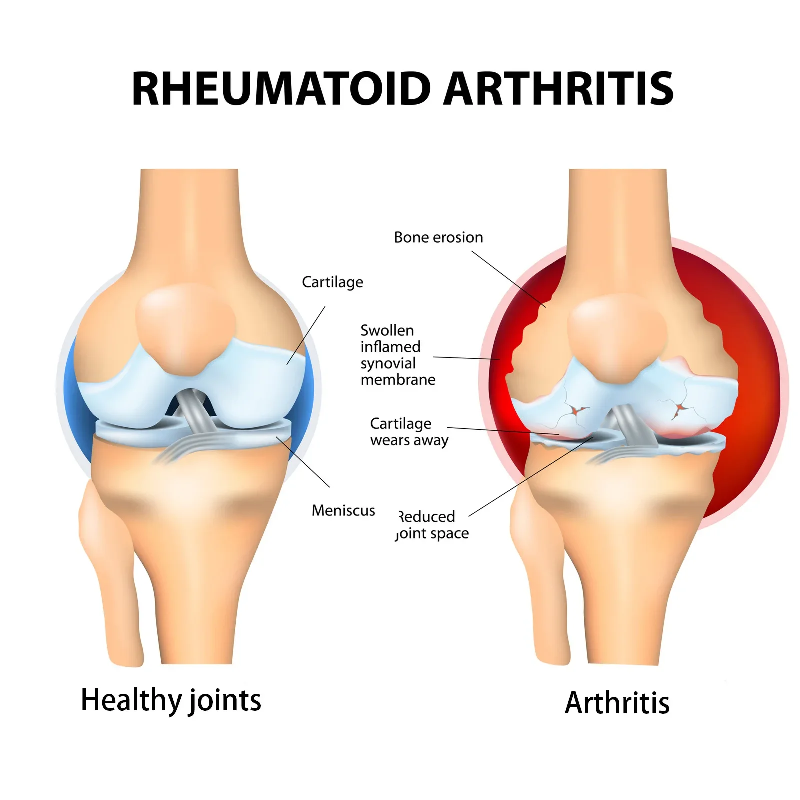 Shoulder Pain Relief Cream Relieve Muscle Soreness Neuralgia Neck Waist Legs Foot Bone Joint Arthritis Rheumatic Cream