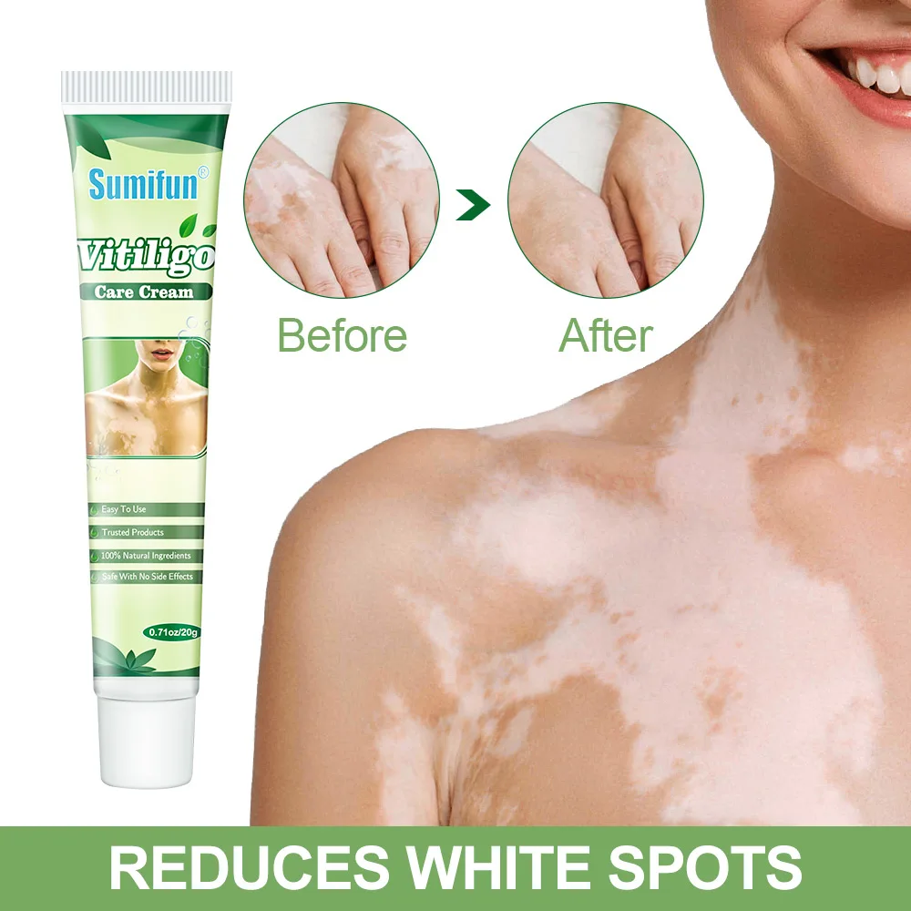 10Pcs Sumifun Vitiligo Repair Cream White Spot Disease Treatment Ointment Localized Leukoplakia Nourishing Skin Chiense Medicine