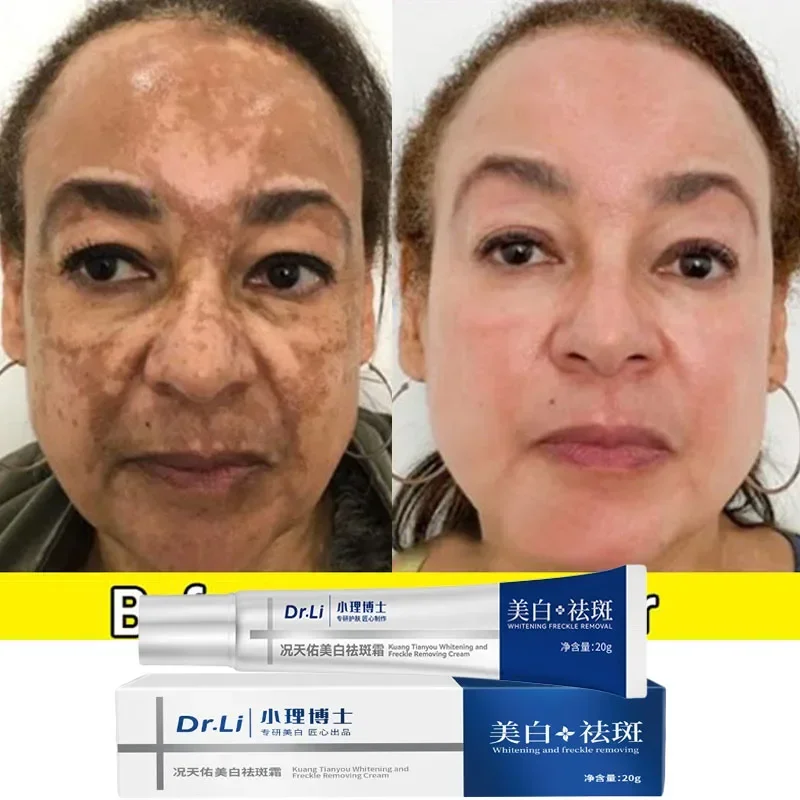 Effective Whitening Freckles Cream Remove Melasma Dark Spots Fade Pigmentation Moisturize Brighten Face Korean Skin Care Product