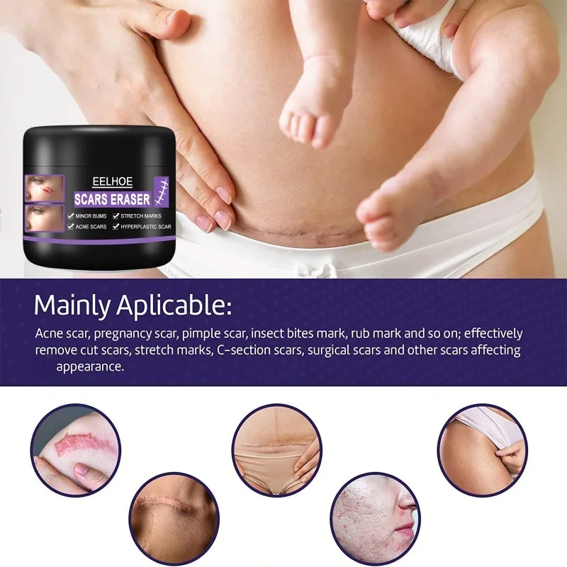 Scar Removal Cream Repair Stretch Marks Burn Surgical fade Acne old Scars Treatment Gel Whitening Beauty skin Health Care