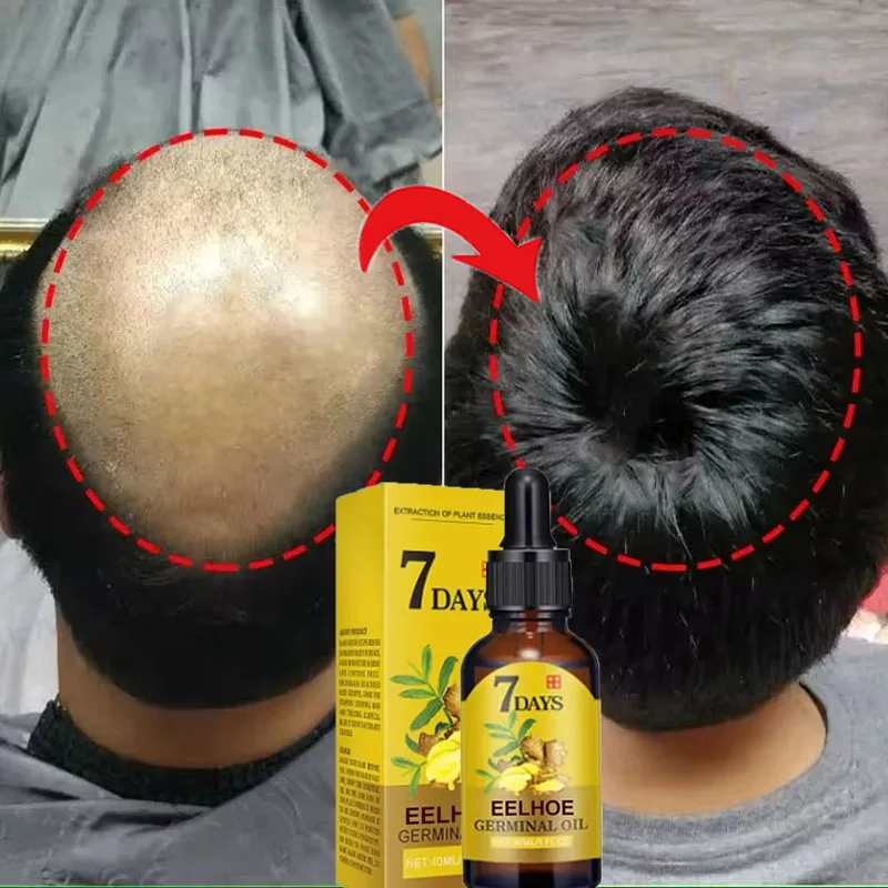 مصل الزنجبيل لنمو الشعر السريع، منتجات مكافحة تساق...