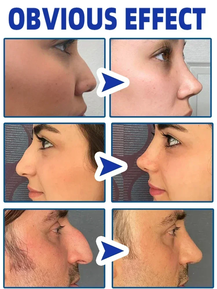 รleo essencial para levantar o nariz, levantar o nariz, cuidado natural, fino, menor, altura, rinoplastia