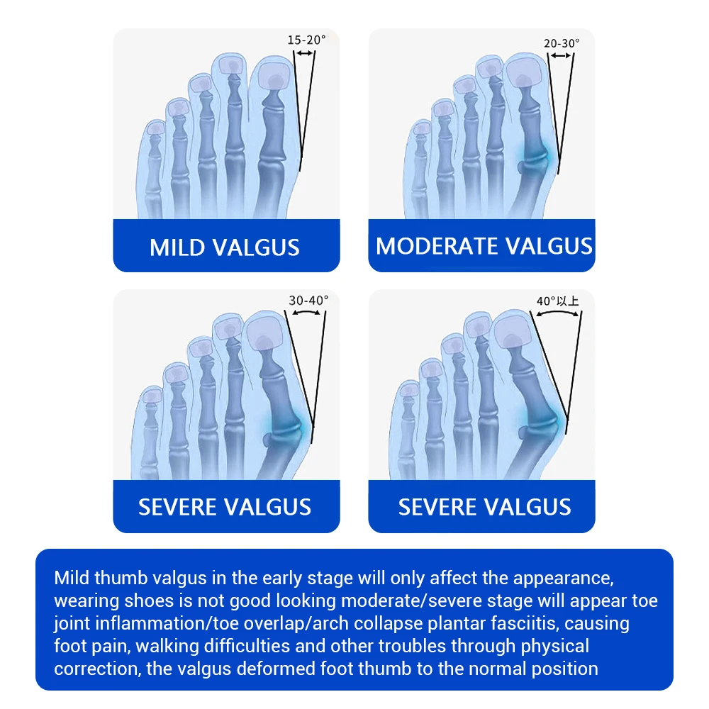 Unisex Bunion Corrector Foot Hallux Valgus Braces Rotatable Big Toe Separator Straightener Adjustable Pedicure Toe Corrector