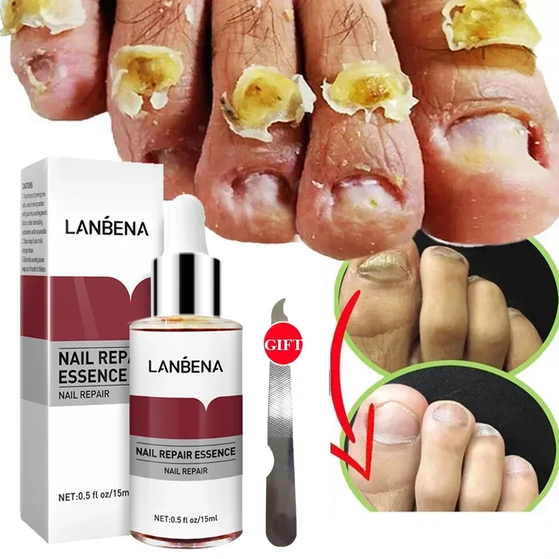 

LANBENA Nail Fungus Treatment Essence Serum Hand Care Foot Fungal Removal Repair Gel Anti-infective Paronychia Onychomycosis