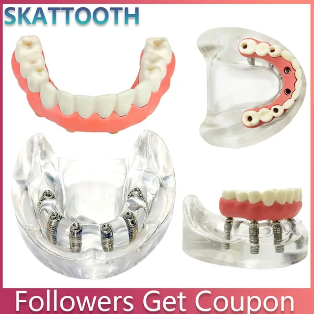 Dental Lower Tooth Implant Model Overdenture Teeth Removable Implant Model for Researching Medical Dentist Teaching Studying