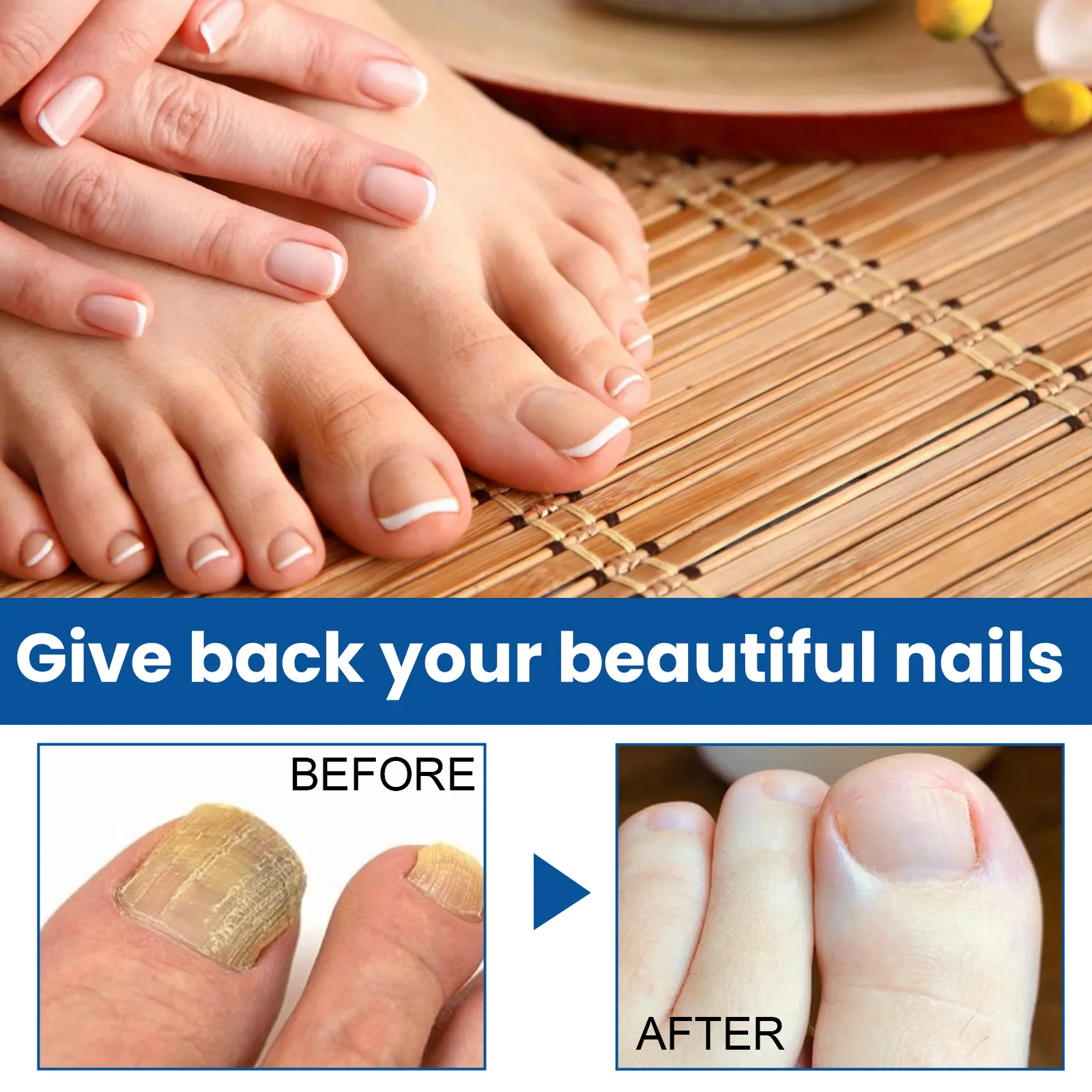 30ML Fungal Nail Treatment Removal Oil Foot Fungus Repair Essence Toe Fungus Removal Gel Anti Infection Best Essenice 발톱무좀