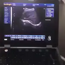 Endoscope médical à ultrasons, système 3D portable