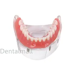 NEW Dental Implant Tooths Model Overdenture Inferior with 4 Implants Demo #6003