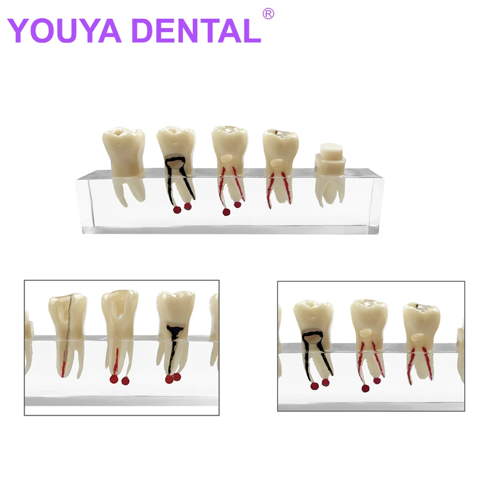 

Dental Endodontic Treatment Teeth Model Pulp Restoration Pathological Teeth Model Transparent Base Teaching Demo For Dentist