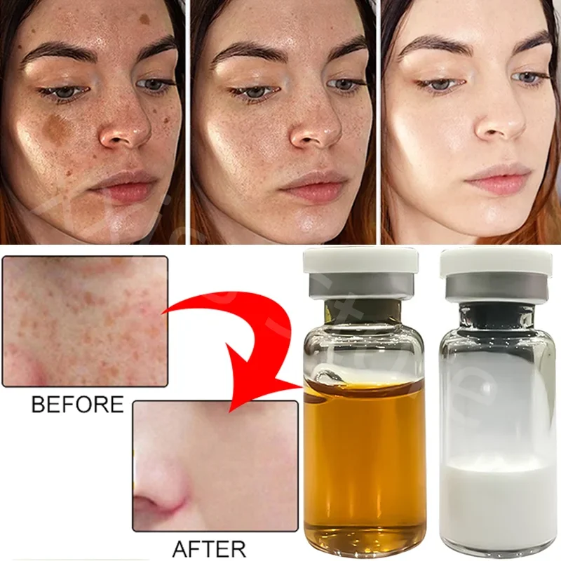 Non-invasive freckle solution freckle whitening fading stain decomposition pigment freckle color removal liquid