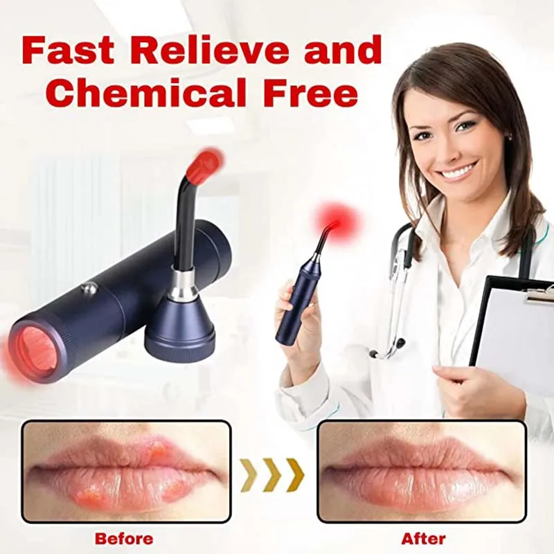 Body Pain Relief Equipment Laser Treatment Of Oral Ulcers And Cold Sores Three-In-One Cold Sore Treatment Device intraoral endoscope camera cheap price for wired treatment oral endoscope