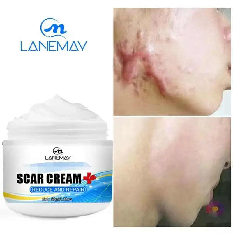 Scar Removal Cream Repair Stretch Marks Burn Acne Surgical Scars