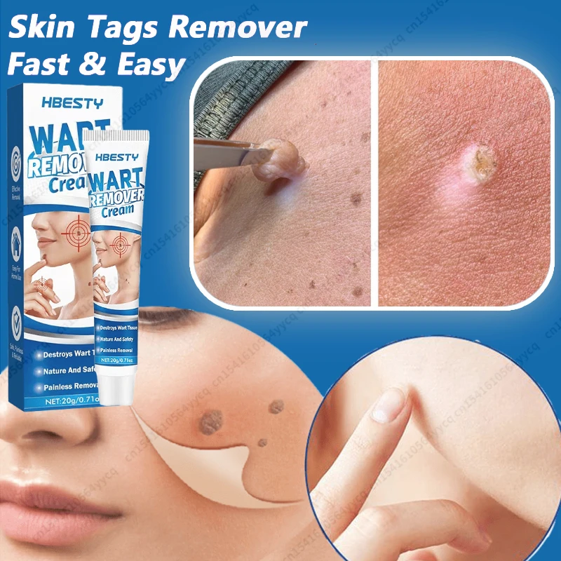 

Wart Removal Mole Remedy Liquid Pen Treatment Papillomas Removing Skin Labels Flat Wart Genitals Painless Beauty Herbal Cream