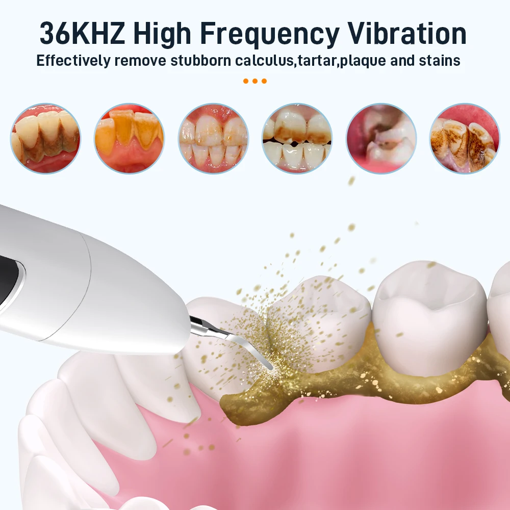 Schoben Ultrasonic Dental Scaler for Teeth Tartar Stain Tooth Calculus Remover Electric Sonic Teeth Plaque Cleaner Stone Removal