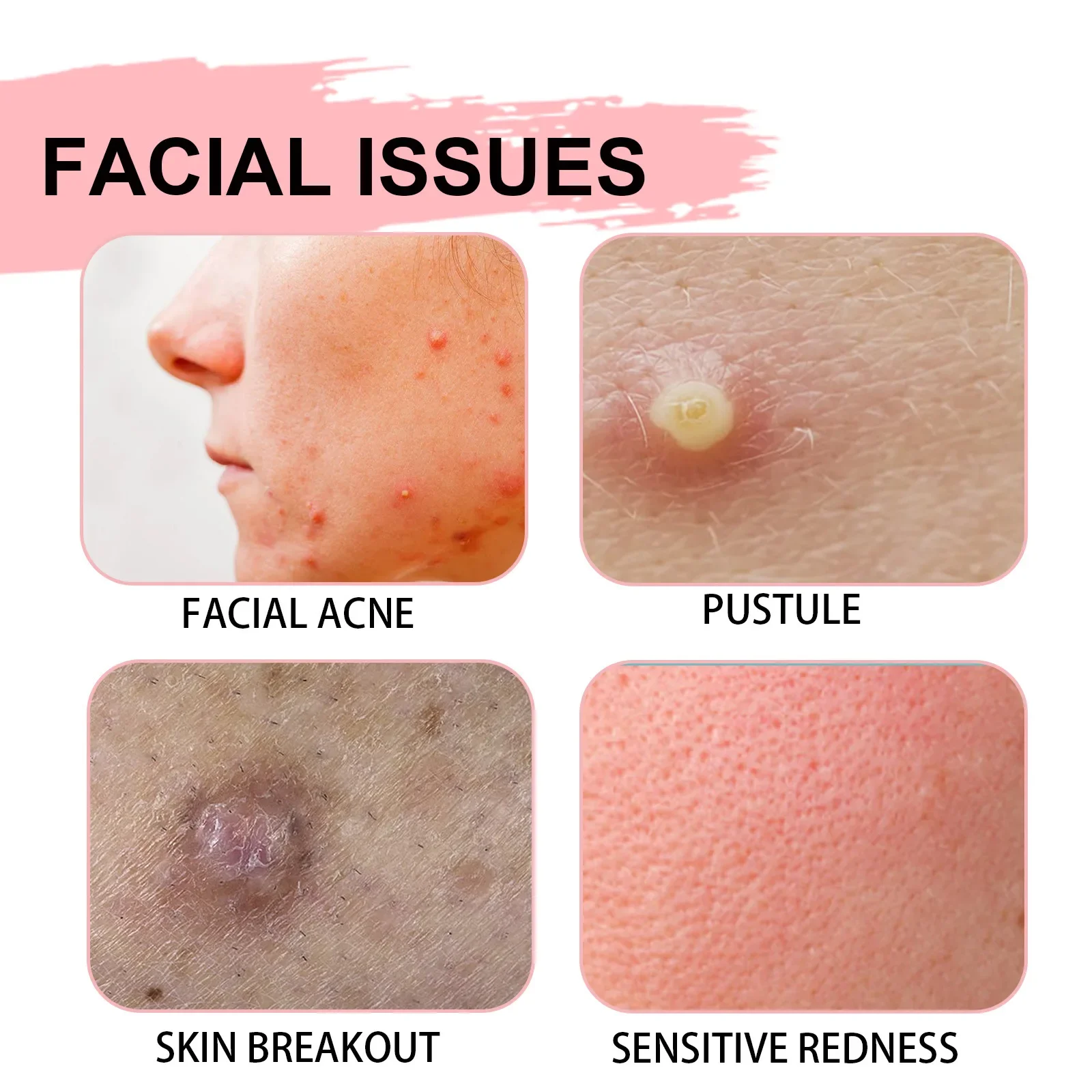 Salicylic Acid Facial Lotion Shrink Pores Nourish Damaged Skin Treat Acne Remove Spot Whiten Face Essence