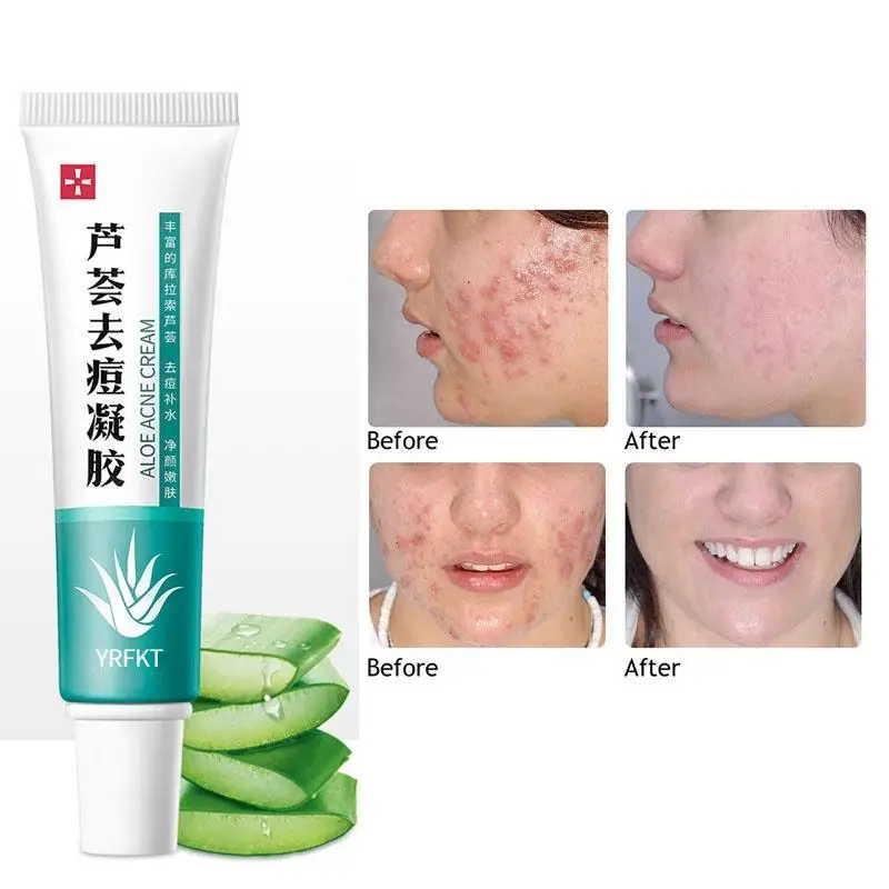 Anti-Acne Cream with Aloe Vera Extract Shrink Pores Sleep Cream