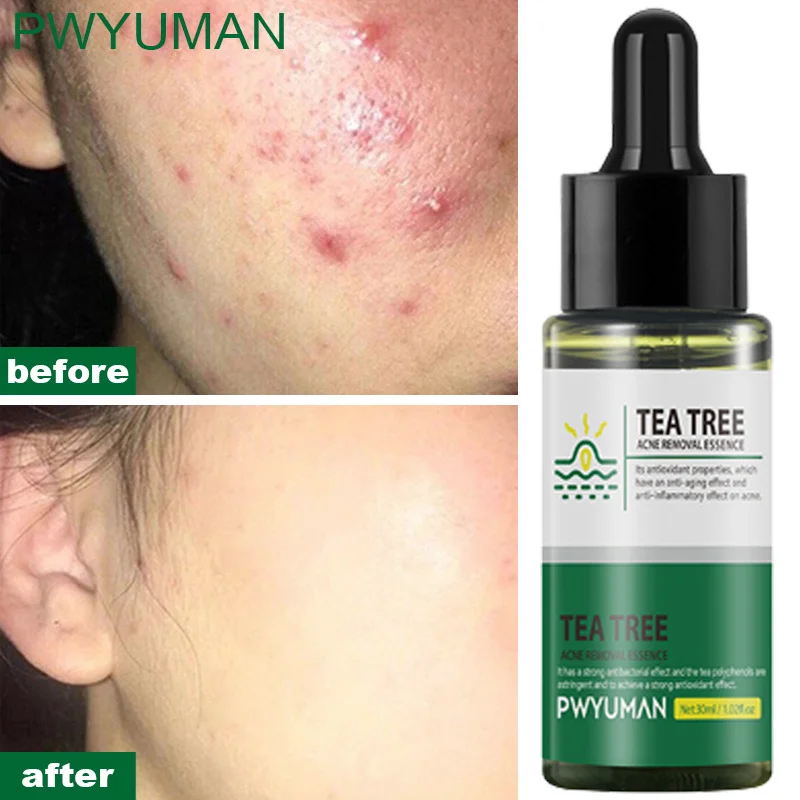 

Tea Tree Acne Removal Face Serum Shrink Pores Tighten Skin Lighten Pimple Marks Dark Spots Whitening Moisturizing Liquid 30ml