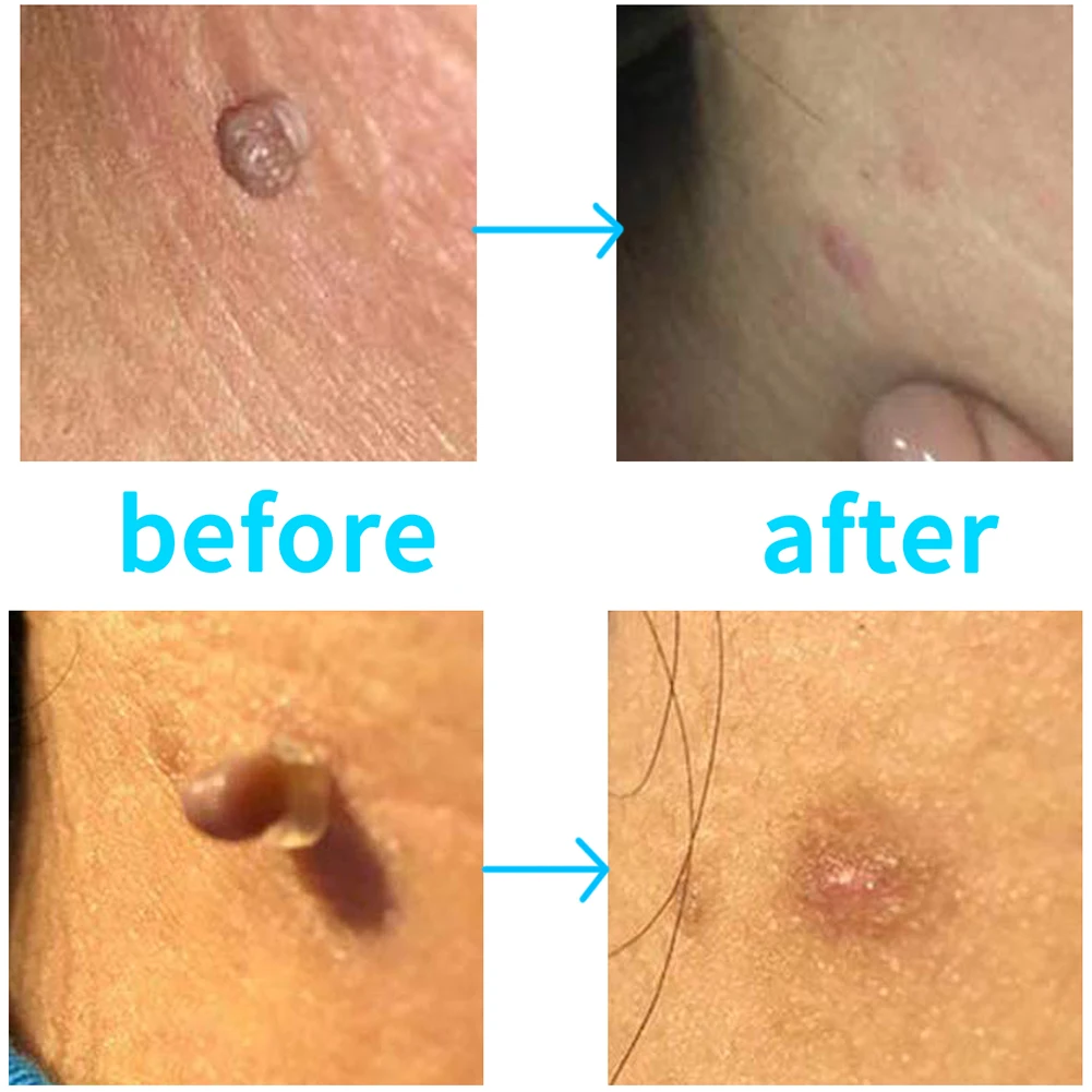 Warts Acne Pimple Treatment Kits 1