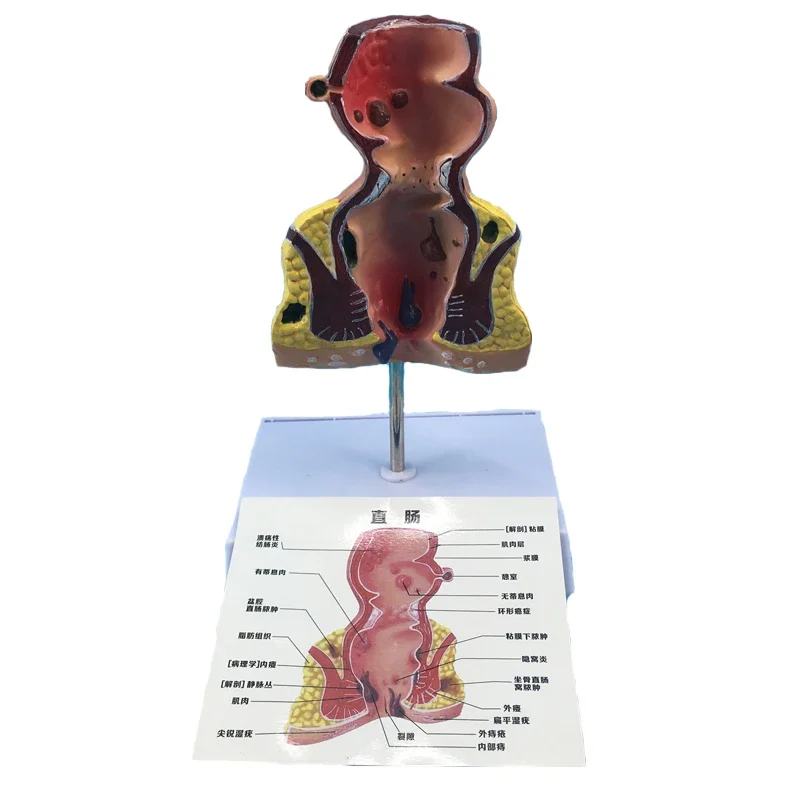 

Human Pathologies of Rectum Anatomical model Hemorrhoid Pathological Diseases Intestine Medical Teaching Learning Too
