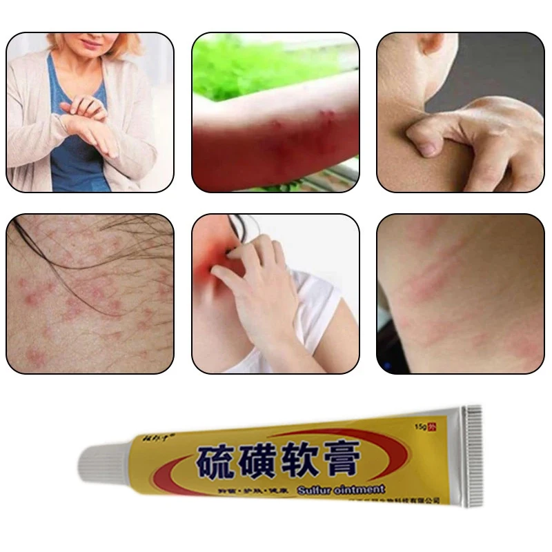 

15g Sulfur Psoriasis Ointment Eczema Skin Allergies Pruritus Cream Dermatitis Antipruritic Herb Medicine Repair Care Dressing