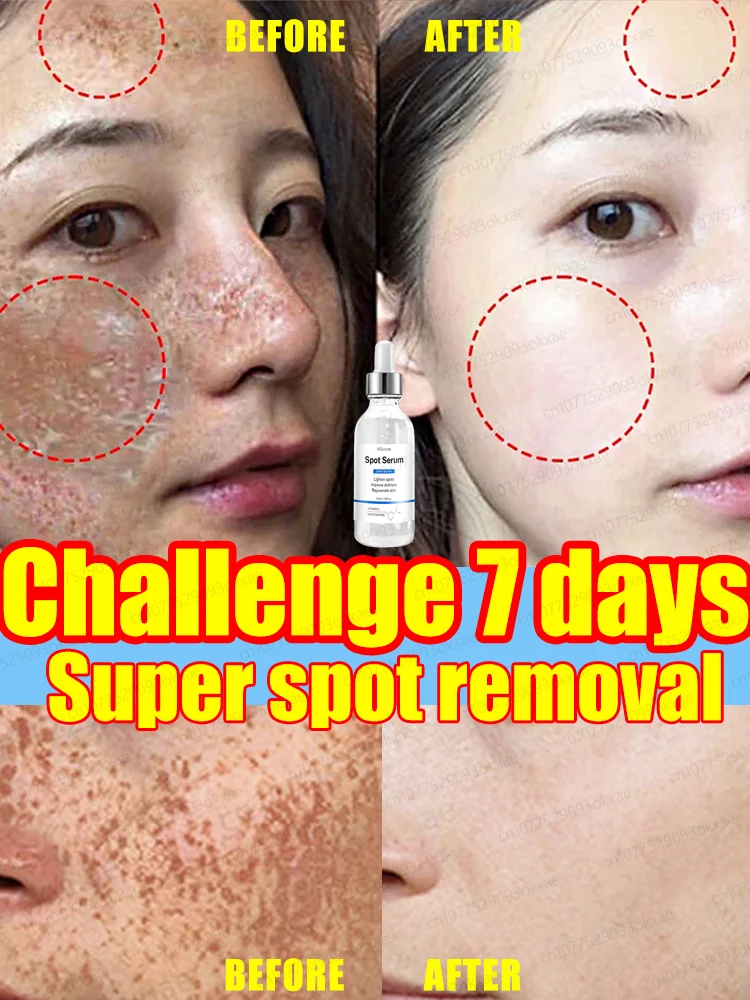 Quickly Freckle Removal Improve Freckle Dark Spots Sun Melasma Remove Age Spots Lightening Melanin Whitening Facial Skin Care remove melanin exfoliating oil bleaching dark skin mud rubbing pore cleaner spots removal whitening cleaning yellow peeling oil