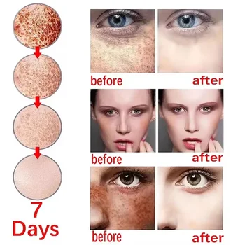 Effective Whitening Freckles Face Cream Remove Melasma Dark Spots Fade Melanin Acne Scars Anti-aging Brighten Repair Skin Care - Thumbnail 6