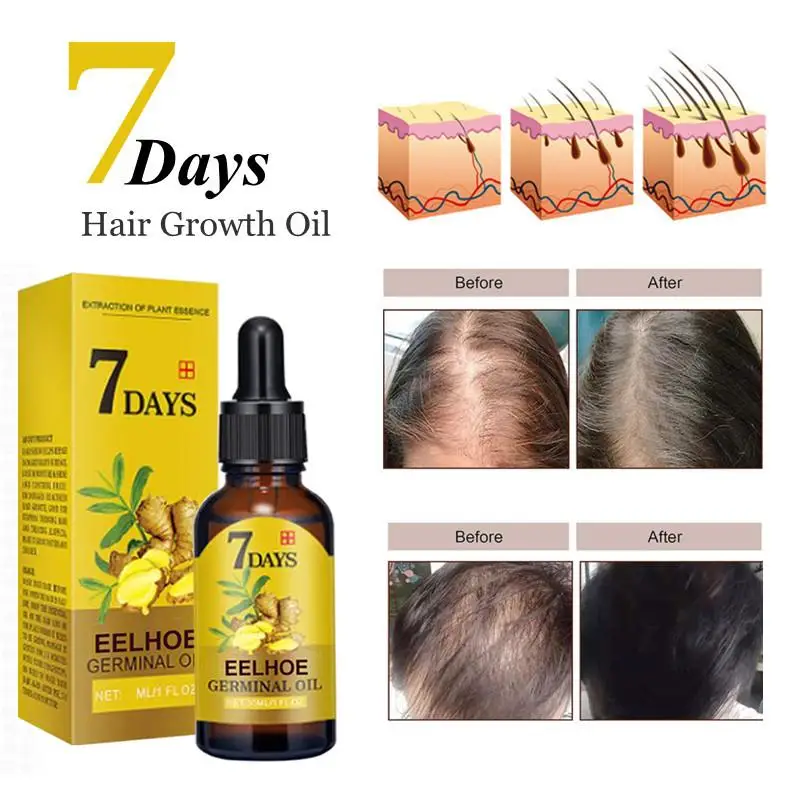 

Hair Growth Products For Men Women Ginger Fast Growing Hair Essential Oil Prevent Hair Loss Oil Scalp Treatment Beauty Hair Care