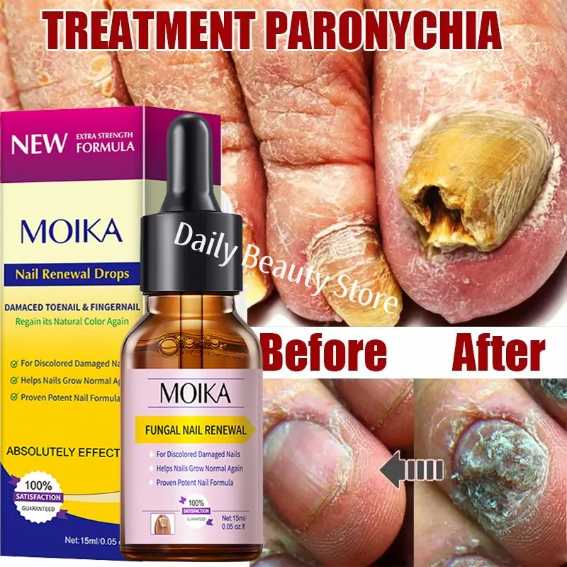 Fungal nail treatment serum foot nail fungus removal repair gel anti infection paronychia onychomycosis foot nails care essence