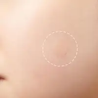 72Pcs Invisible Removal Pimple Anti-Acne Hydrocolloid Patches Spots Marks Concealer Waterproof Repair Sticker 2
