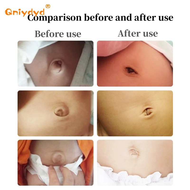 Infant Inguinal Umbilical Hernia Belt Navel Support Stickers Treatment Newborn Baby Belly Button With 3 Hernia Pad