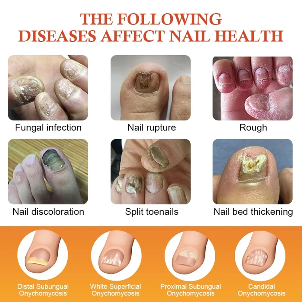 Fungal Nail Laser Device Removes Nail Fungus Toenail Fingernail Repair Hand&Foot Care