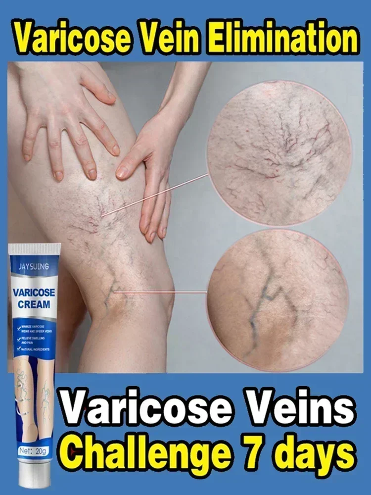 Varicose Vein Ointment Effective Relief Vasculitis Spider Legs Pain Treatment Care Essential