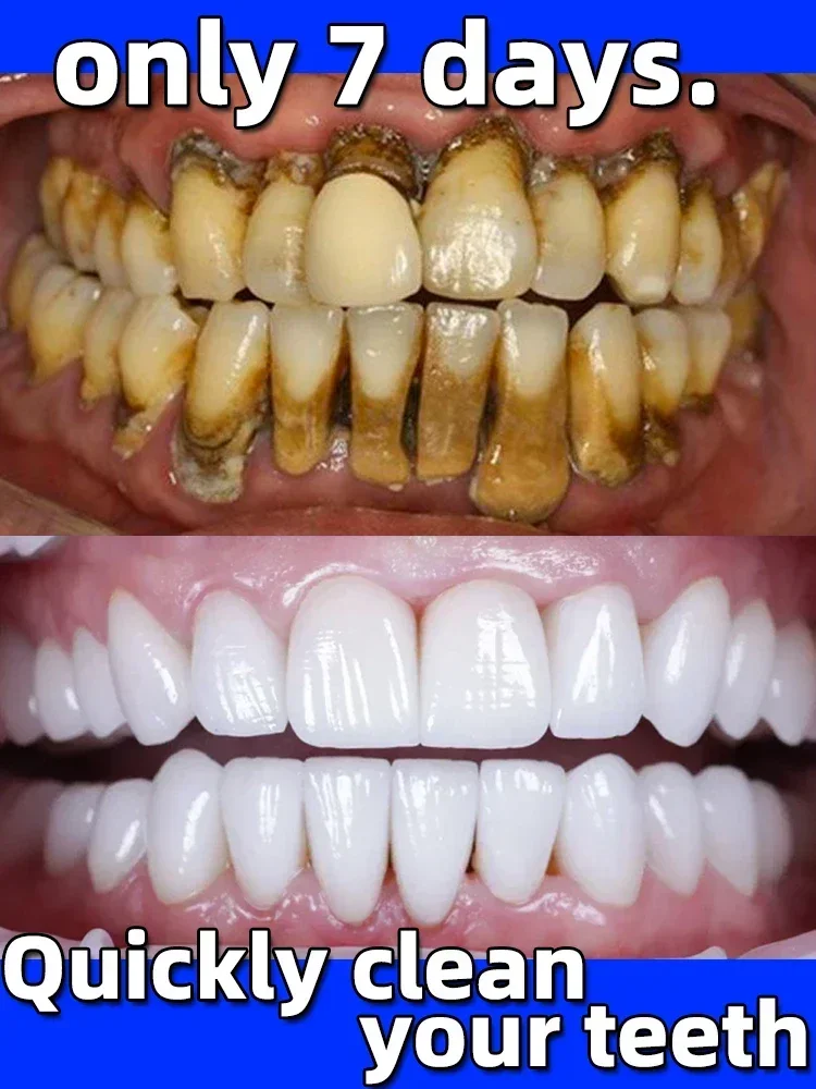 Dental Calculus Remover Teeth Whitening Product Mouth Odor Removal Bad Breath Preventing Periodontitis