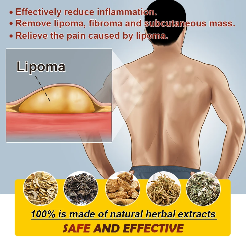 Pain relief cream,skin care ointment 1Pcs Lipoma Removal Cream Relief Pain Skin Swelling Lipolysis Cellulite Fat Lump Nodule Removal Ointment Anti-tumor Plaster G040