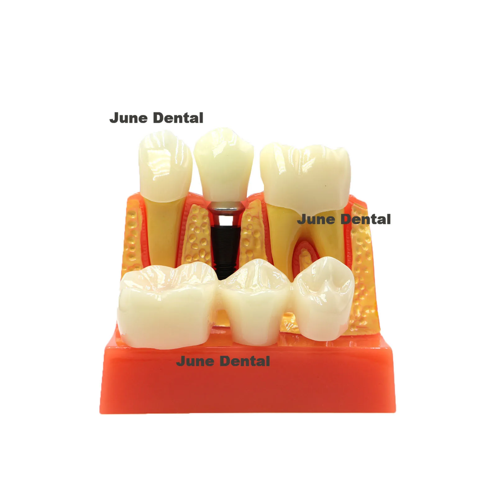 

Dental Demonstration Teeth Model Implant Analysis Crown Bridge for Dentist 2017