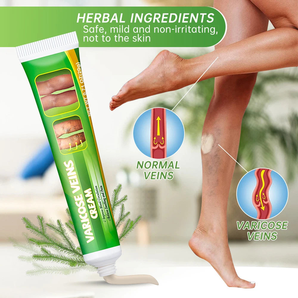 Varicose Veins Laser Treatment Cream Effective Relieve Legs Dilated Vasculitis Phlebitis Natural Formula Ointment Varicose Veins