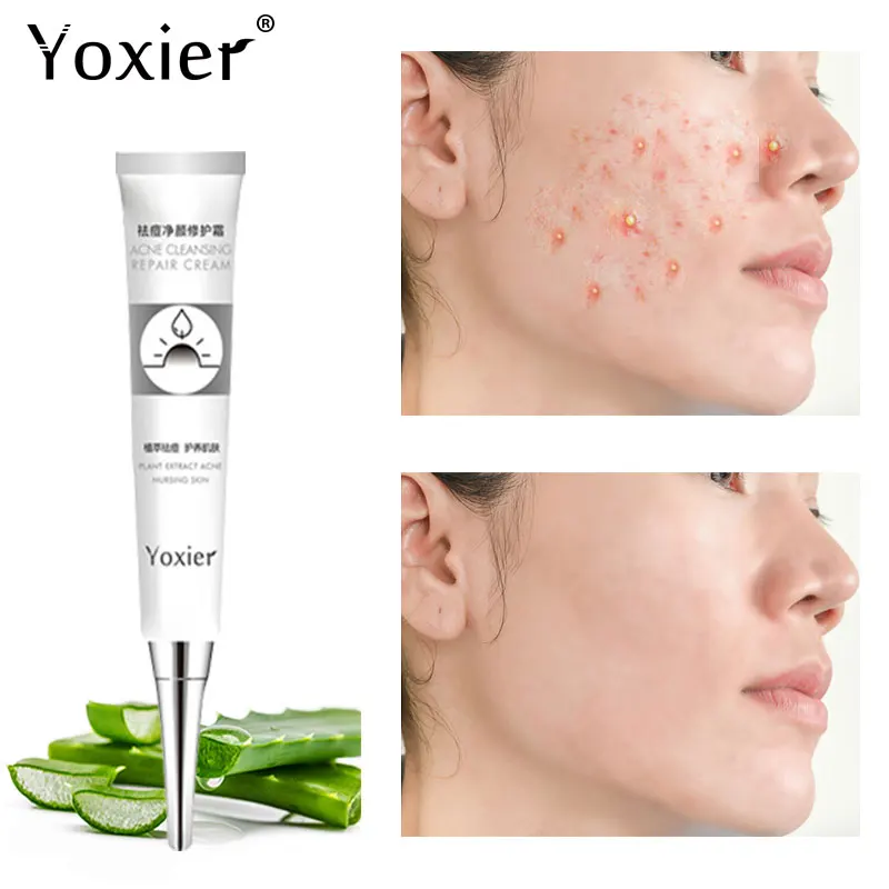 

Acne Cleansing Repair Cream Removal Pimple Blackhead Oil-Control Fades Acne Marks Shrink Pores Aloe Extract Face Skin Care 20g