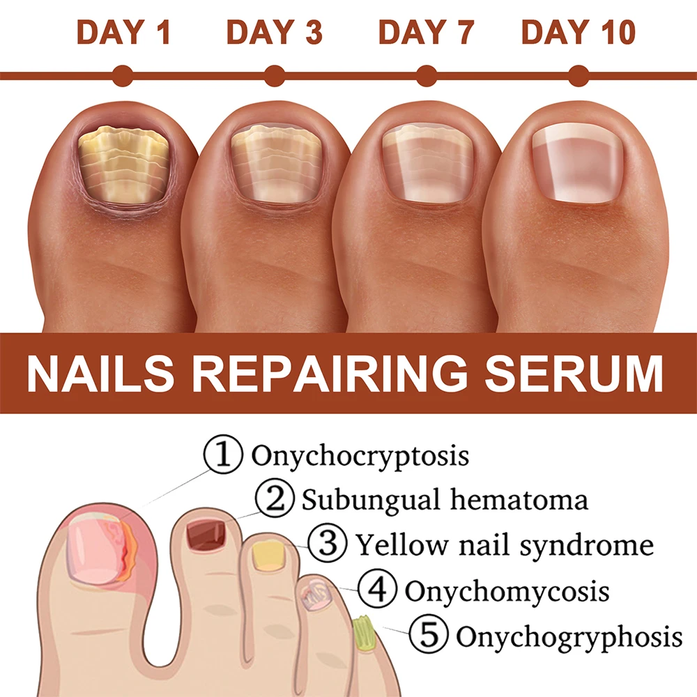 Nail Fungus Treatment Serum Toe Fungal Repair Products Hand Foot Care Removal Gel Anti Infection Onychomycosis Paronychia nail fungus remover