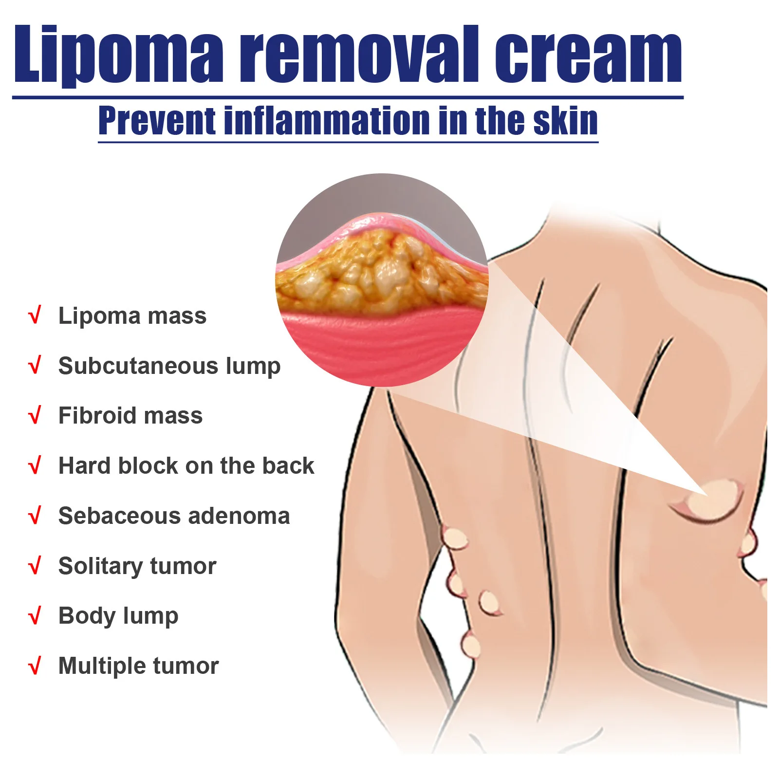 Anti-Tumor Ointment Fat Soluble Mass Subcutaneous Lump Treatment Anti-Adipose Tissue Hyperplasia Swelling Fibroma Removal Cream