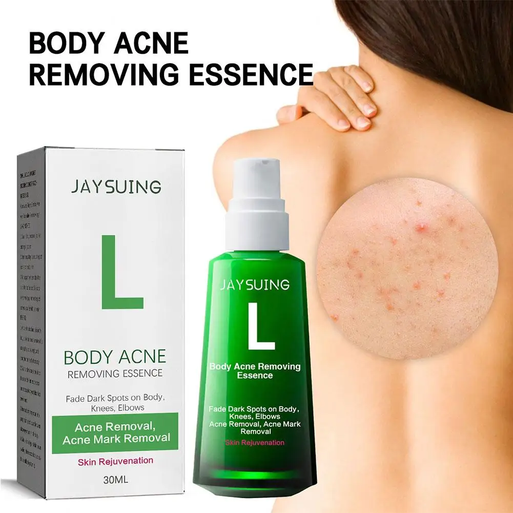 30ml Acne Remover Face Serum Herbs Acne Treatment Pimple Remover Shrink Pores Oil Control Face Herb Acne Skin Care_voghion.com