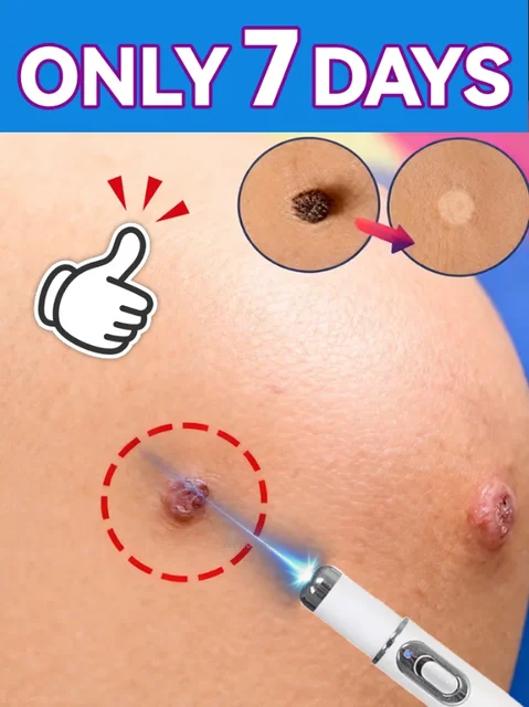 ปากกาไล่หูดแสงสีฟ้า ขายดีปี 2025 อุปกรณ์ดูแลหูดขายดี 1