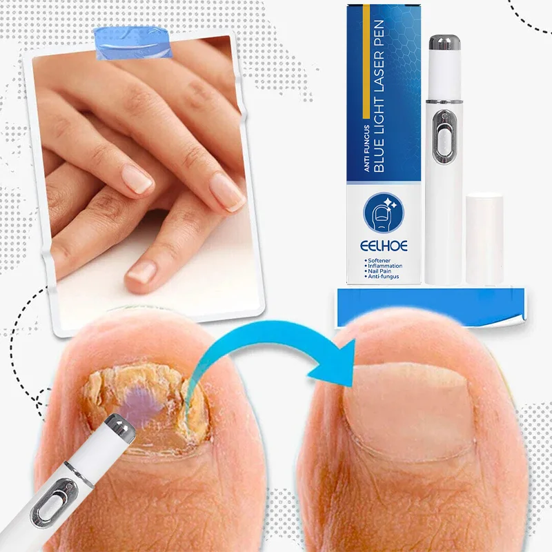 Nail Fungal Treatment Feet Care Essence Repair Nail Fungus Removal Serum Gel Anti Infection Paronychia Onychomycosis