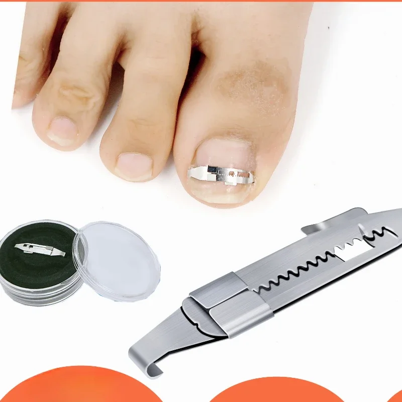 Toe Corrector Ingrown Toenail Corrector Tools Pedicure Recover Embed ToeFoot Care Tool Nail Treatment Professional Ingrown Toenail Correction