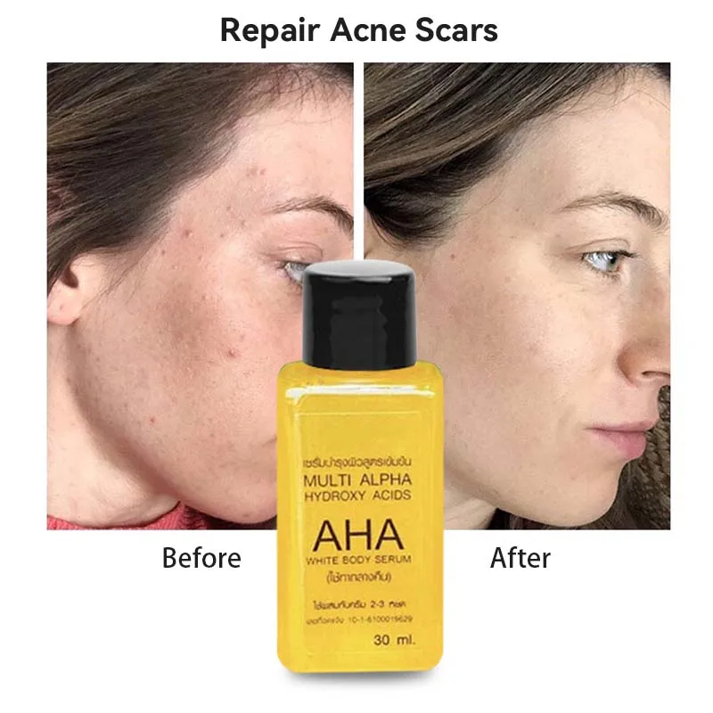 AHA Alpha Hydroxy Acid Whitening Body Serum Brightening Moisturizing Remove Melasma Dark Spot Korean Skin Care Skincare Products