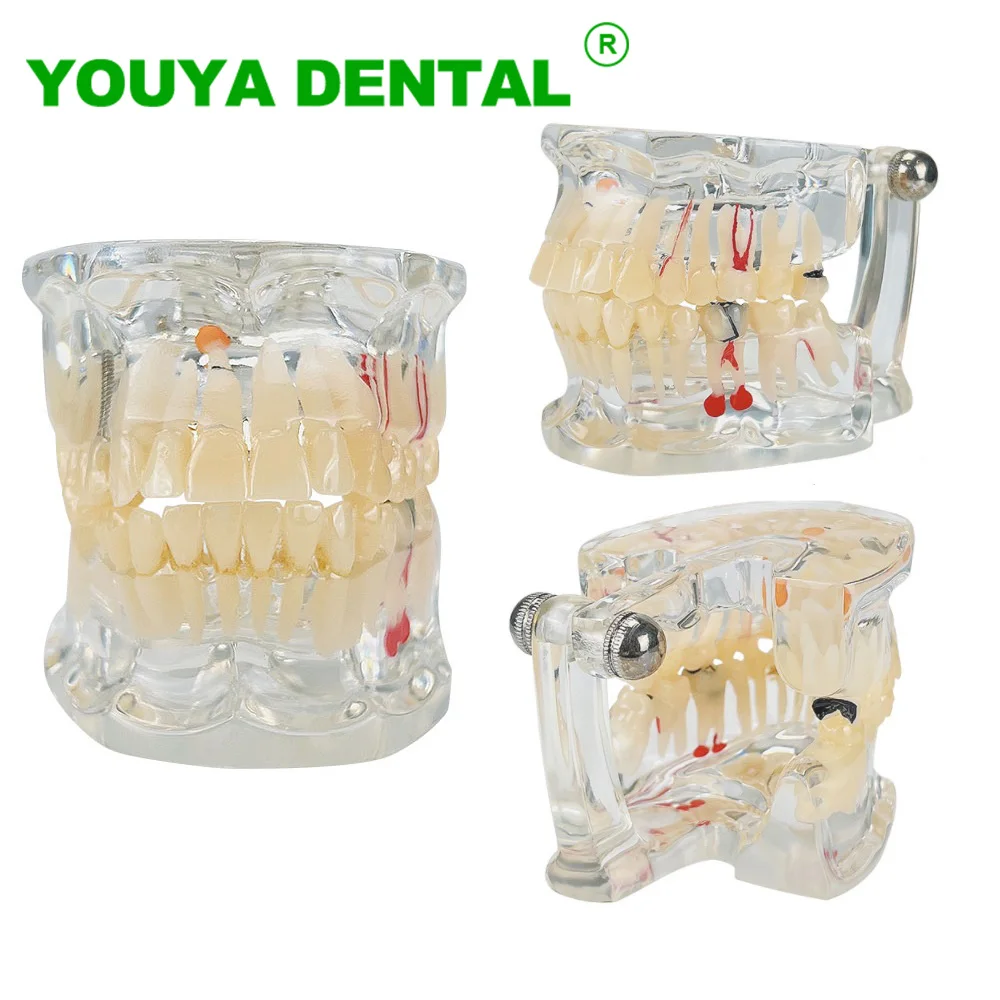 

Dental Demonstration Model Disease Caries Missing Teeth Model Implant Practice Model For Doctor Dentist Patient Communication