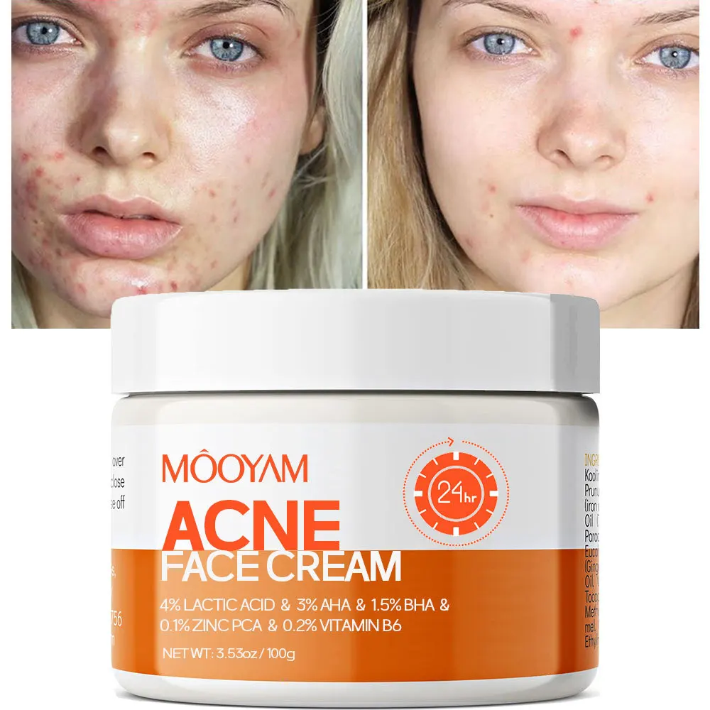 

Acne Removal Face Cream Centella asiatica Anti-ance Creams Acne Treatment Repair Remover Skin care Facial Cream Korean Skincare